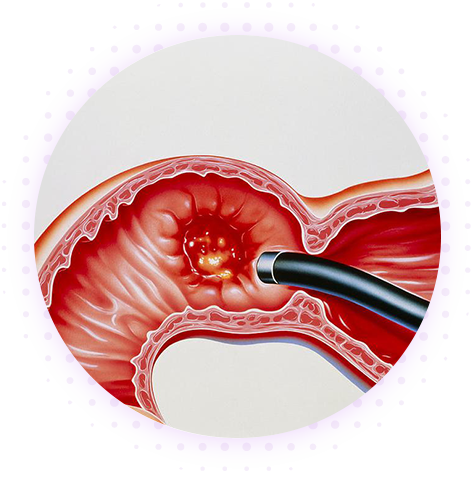 Язва двенадцатиперстной кишки (ЯДПК)