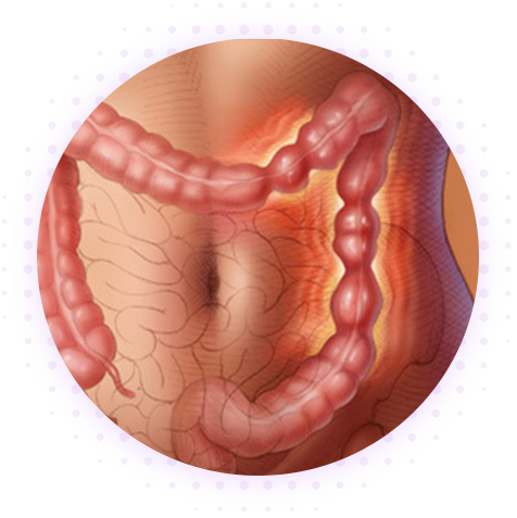 Синдром раздражённого кишечника (СРК)