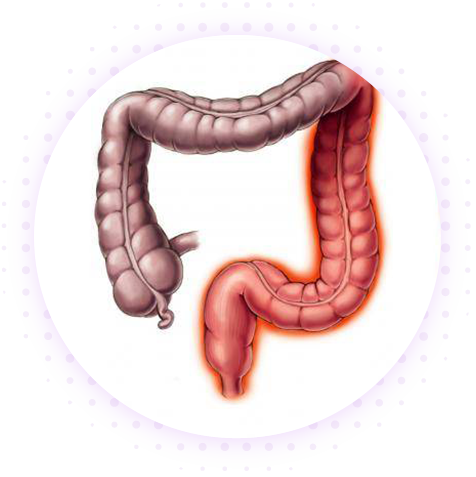 Неспецифический язвенный колит (НЯК)