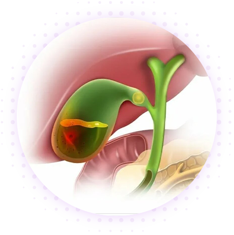 Холецистит