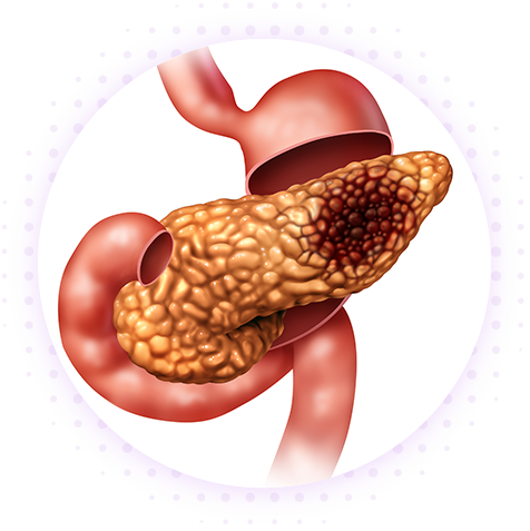 Панкреатит